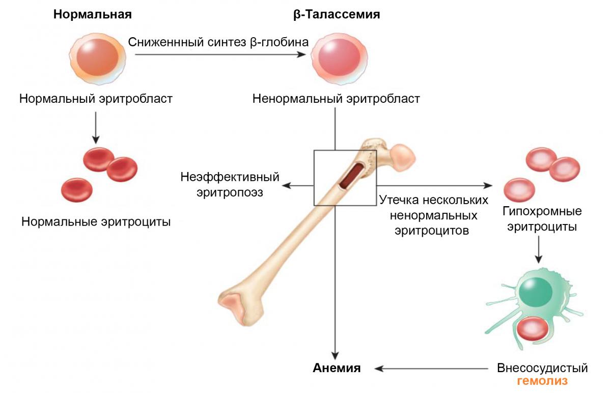 Патогенез β-талассемии